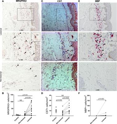 The Number of MRGPRX2-Expressing Cells Is Increased in Skin Lesions of Patients With Indolent Systemic Mastocytosis, But Is Not Linked to Symptom Severity